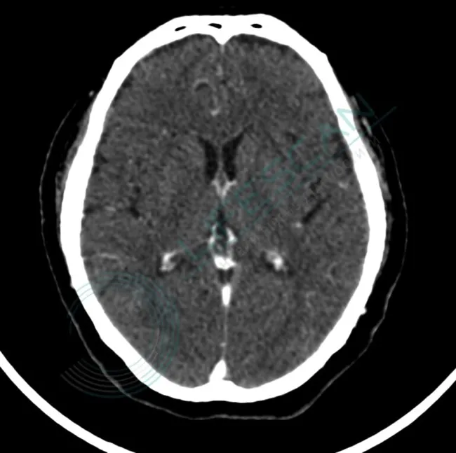 Фактори ризику пухлин головного мозку Фактори ризику пухлин головного мозку