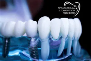 Имплантация зуба в Харькове: цены, процедура и преимущества