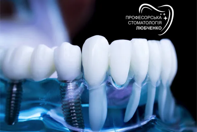 Имплантация зуба в Харькове: цены, процедура и преимущества