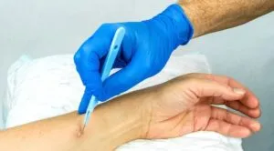 Абсцес: причини появи та як правильно лікувати